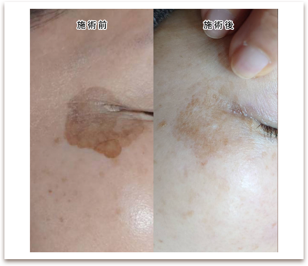 施術前/施術後の写真