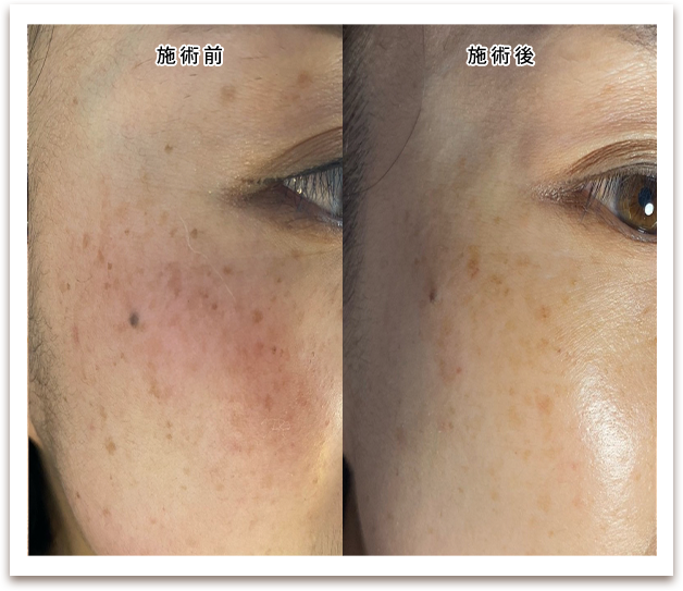 施術前/施術後の写真