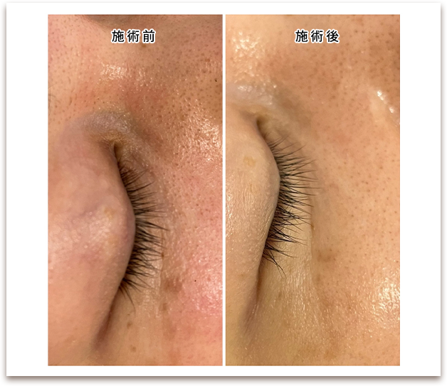 施術前/施術後の写真