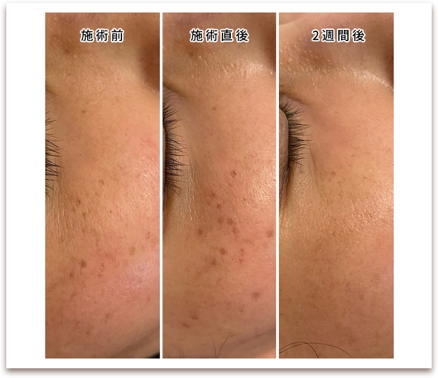 施術前/施術後の写真